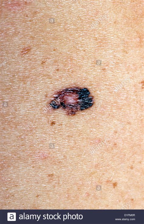 Malignant Melanoma Skin Stock Photos And Malignant Melanoma Skin Stock