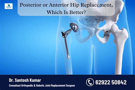 Posterior Or Anterior Hip Replacement Which Is Better Momentum