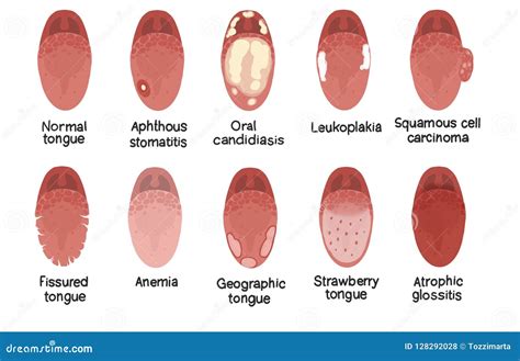 Tongue Disease Vector Of Organ Concept 130146802