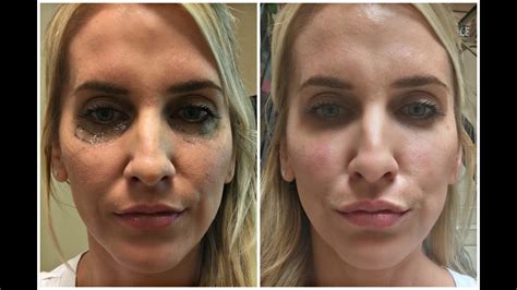 under eye filler before and after pictures goo to play