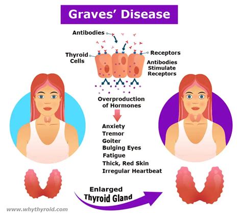Graves Disease Symptoms Causes Risk Groups Convention