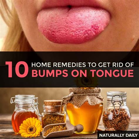 How To Get Rid Of Lie Bumps On Tongue Top 10 Home Remedies