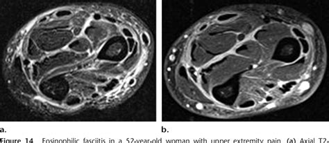 Figure 1 From Soft Tissue Infections And Their Imaging Mimics From