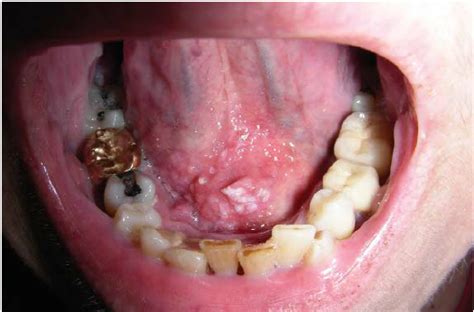 Lesion On The Anterior Floor Of The Mouth With Irregular Fungating