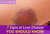 Poor Liver Health Symptoms Photos
