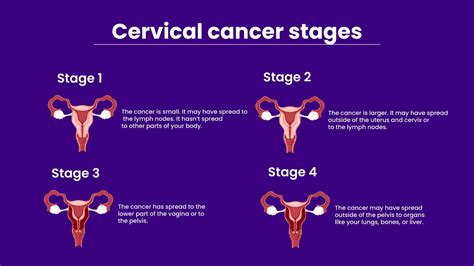 Cancer De Cervix