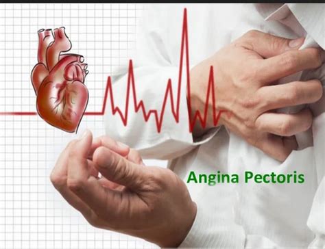 Angina Pectoris Treatment Service And Abdominal Aortic Aneurysm