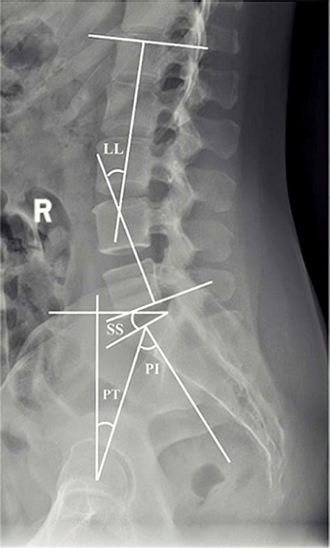 Measurement Of Sagittal Spinopelvic Parameters In The Lumbar Spine