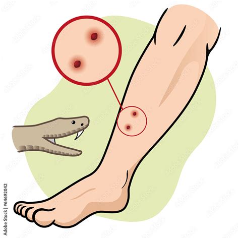 First Aid And Snake Bite In The Leg Stock Vector Adobe Stock