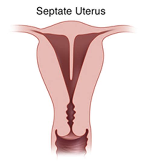 Learn about the symptoms, causes, and how to manage it. Endometriosis معنى : Ø§Ù„Ø§Ù†ØªØ¨Ø§Ø° Ø§Ù„Ø¨Ø·Ø§Ù†ÙŠ Ø§Ù„Ø ...