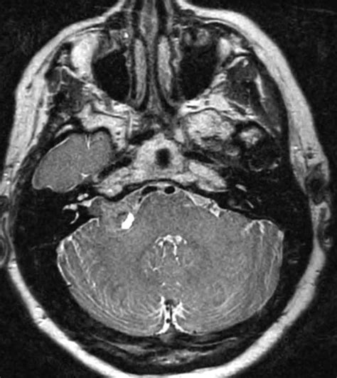 Vestibular Schwannoma. - Neuro MR Case Studies - CTisus CT ...
