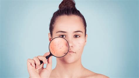 6 Skin Conditions That Look Like Acne But Isnt Acne Dr Terry Loong