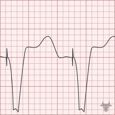 Pacemaker Mediated Tachycardia Ecg Stampede
