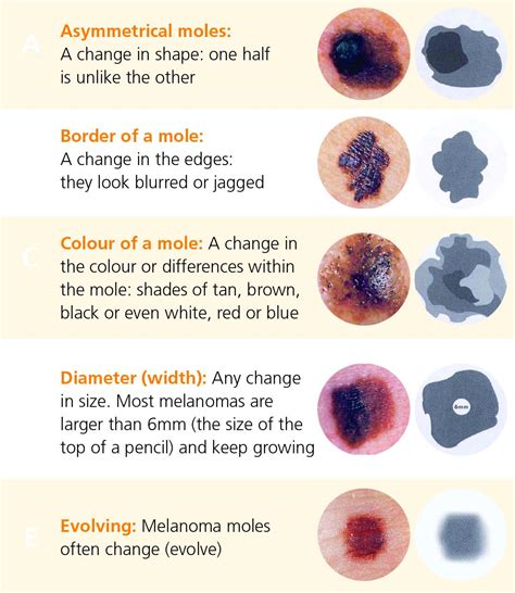Signs Of Melanoma Skin Cancer