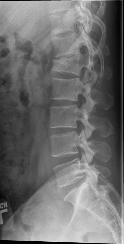 Lumbar Spine Fracture Buyxraysonline