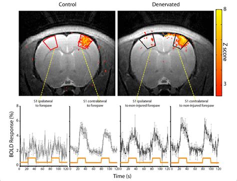 Functional Magnetic Resonance Imaging Fmri Responses In Healthy And