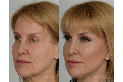 Facelift Before And After Gallery Dr Cory Torgerson
