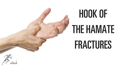 Hook Of The Hamate Fracture Mechanism Of Injury And Treatment Of This