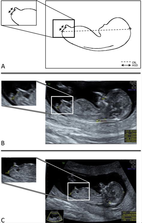 First Trimester Determination Of Fetal Gender By Ultrasound Measurement Of The Ano Genital