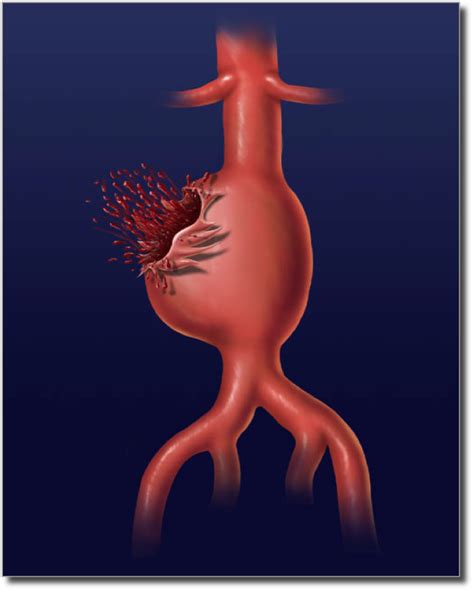 Abdominal Aortic Aneurysm Symptoms And Causes Mayo Clinic