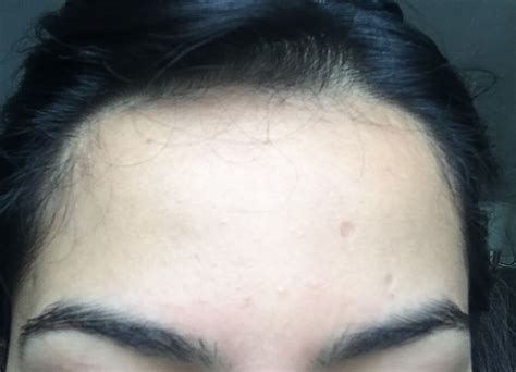 How Can I Get Rid Of Tiny Bumps Covering My Face General Acne