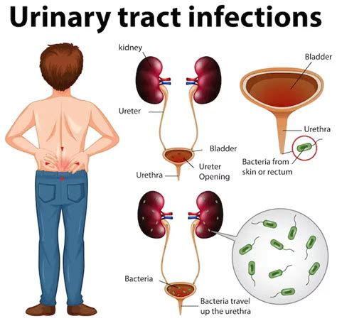 What Doctor To Consult For Uti Ayu Health
