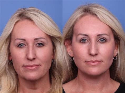 Facelift Before And After Pictures Case 403 Scottsdale Az Hobgood Facial Plastic Surgery