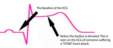 External electrodes are used to measure the electrical conduction signals of the heart and record them as characteristic lines on graph paper (an electrocardiogram; VirtualMedStudent.com || Acute Coronary Syndromes and ...