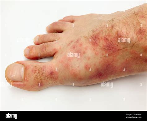 Close Up Of Males Foot And Toes With Red Rash Desease On A White
