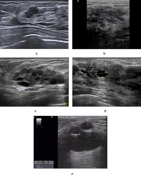 The Ultrasonographic Characteristics Of Focal Fibrocystic Change Of The