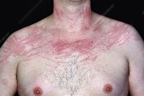 Dermatographic Urticaria Stock Image C0284400 Science Photo Library