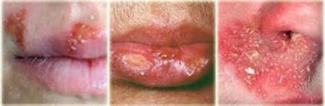 It may result in small blisters in groups often called cold sores or fever blisters or may just cause a sore throat. What causes herpes? - WZ Text
