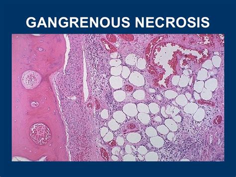 General Pathology Lecture 3 Cell Death Or Necrosis