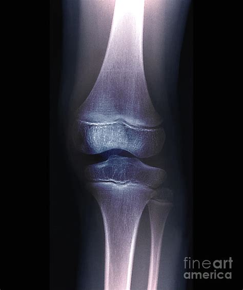 Normal Knee Of A Child Photograph By Zephyrscience Photo Library