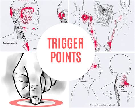 Terapia Trigger Points Cursuri Physio Sport Therapy Academy