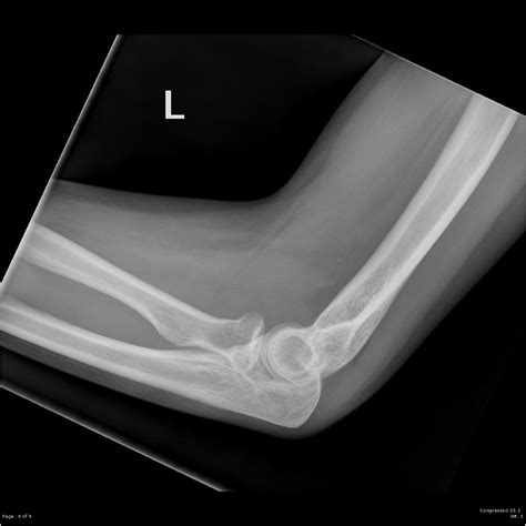 Radial Head Fracture Image