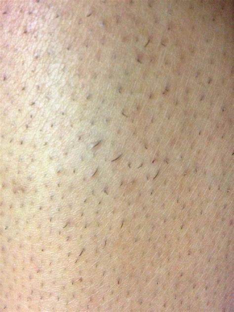 How To Get Rid Of And Prevent Razor Bumps Beauty Mag