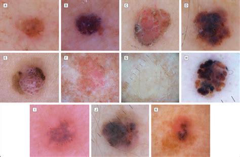 Historical Clinical And Dermoscopic Characteristics Of Thin Nodular
