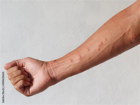 Skin Rash Rashes Caused By Allergic Reactions On Arms Stock Photo