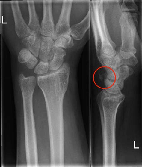 Simultaneous Bilateral Triquetral Fractures Acquired In
