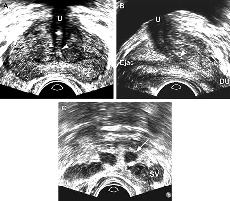 Role Of Transrectal Ultrasonography In Prostate Cancer Radiologic Clinics