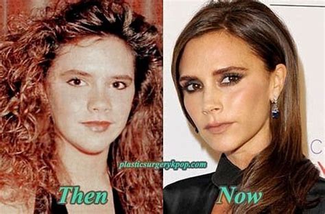 Before And After Victoria Beckham Plastic Surgery Celebrity Plastic Surgery Plastic Surgery
