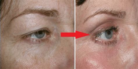 How To Tighten Loose Skin On Eyelids Naturally Fast With