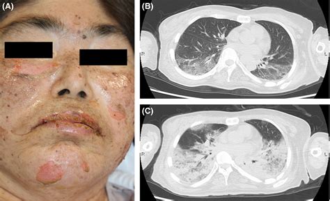 A Case Of Toxic Epidermal Necrolysis With Refractory Acute Respiratory