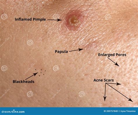 Types Of Acne And Acne On The Skin Enlarged Pores Inflamed Pimple Blackheads Acne Scars