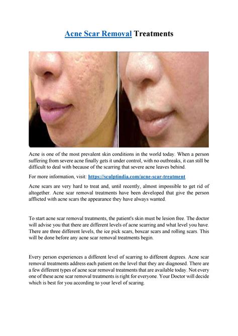 Acne Scar Removal Treatments By Sculpt India Issuu