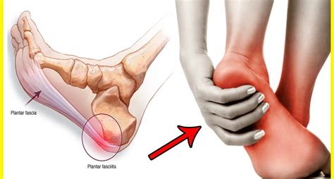Plantar fasciitis is basically a pain in the foot, often in the heel. How Can Plantar Fasciitis be Treated Without Drugs ...