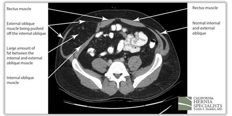 Recent Case Highlights California Hernia Specialists