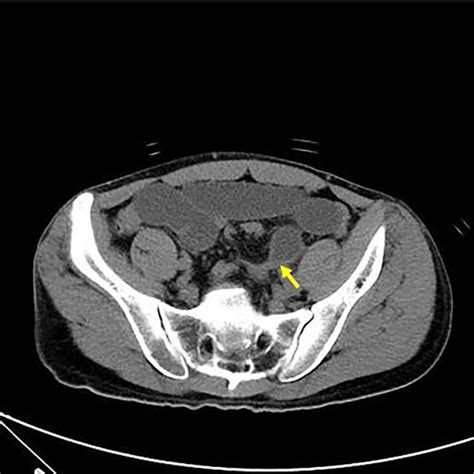 Axial View Of Abdominal Ct Revealing Intersigmoid Hernia With Arrow
