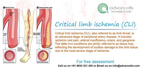 Critical Limb Ischemia Cli Also Referred To As Limb Threat Is An